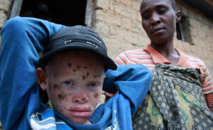 "Albinos in Burundi - hunted for body parts" by IFRC is licensed under CC BY-NC-ND 2.0.