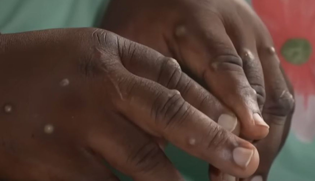 A new strain of mpox is spreading in central African nations that lack the access to vaccines the United States and European countries have had since the global outbreak in 2022. (Source: Screenshot - BBC)